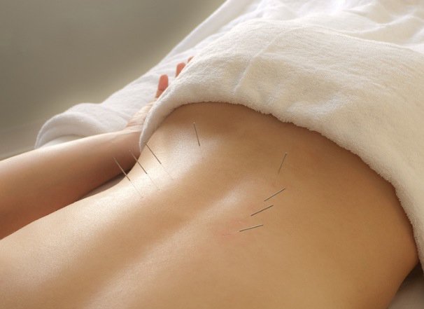 Acupuncture for Sciatica - Everything You Need to Know